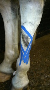 Kinesiotape to aid lymphatic drainage of swelling around wound